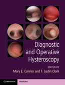 Diagnostic and Operative Hysteroscopy-9781107111608