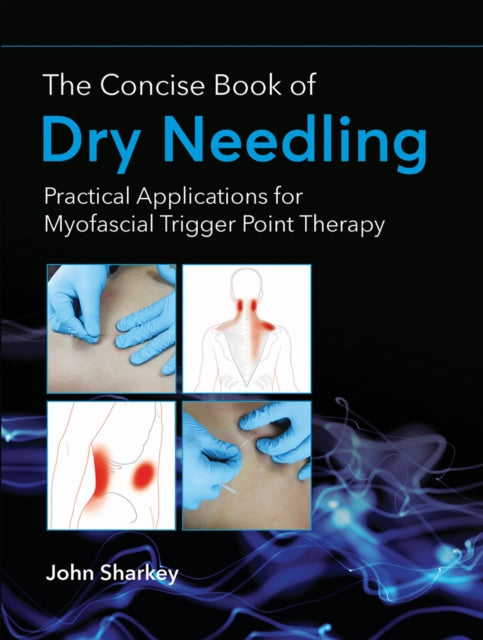 The Concise Book of Dry Needling