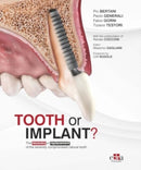 Tooth or Implant-9781957260525